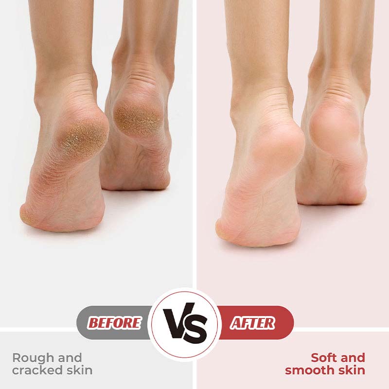 ✨Electric Callus Remover – Smooth Feet in Seconds!✨