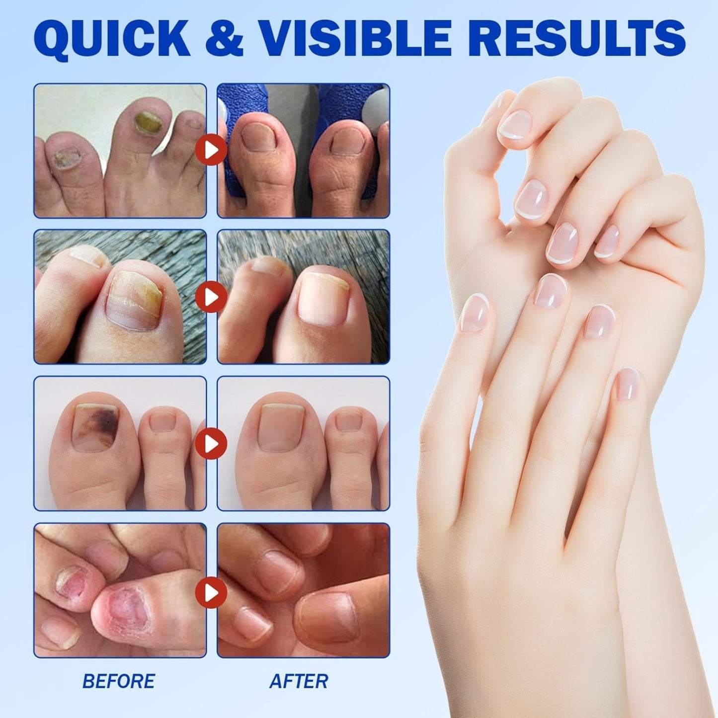 Toenail Fungus Treatment Extra Strength